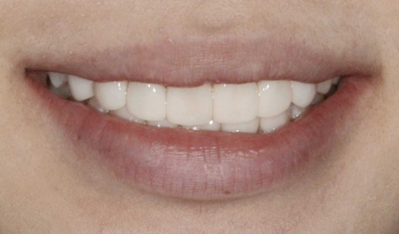 이○○님 치료 후